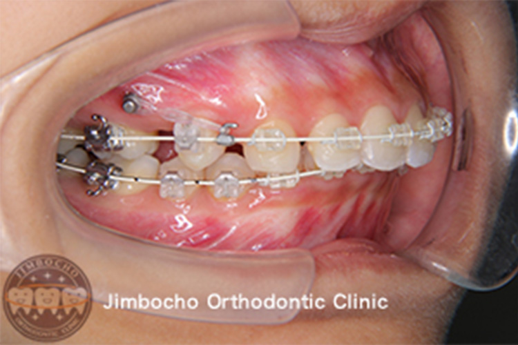 歯科矯正用アンカースクリューを使用した矯正歯科治療
