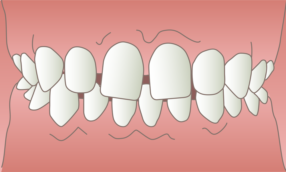 空隙歯列