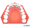 裏側矯正 / 舌側矯正 / リンガルブラケット