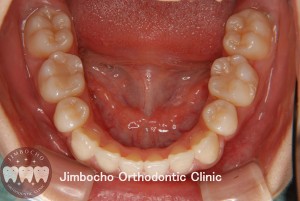 (ブログ) 「叢生（歯並びがガタガタ）の原因と治療法」6