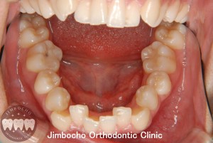 (ブログ) 「叢生（歯並びがガタガタ）の原因と治療法」3