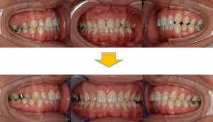 空隙歯列２