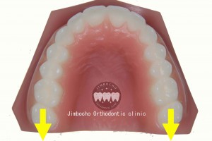 (ブログ) 「足りない隙間の作り方”5パターン”」IMG_0114ロゴ③臼歯部遠心移動ーのコピー