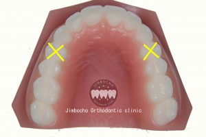 (ブログ) 「足りない隙間の作り方”5パターン”」IMG_0114ロゴ⑤小臼歯抜歯のコピー
