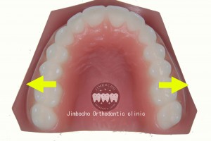 (ブログ) 「足りない隙間の作り方”5パターン”」IMG_0114①側方拡大