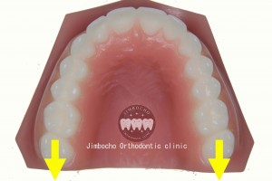 (ブログ) 「臼歯遠心移動とインビザライン」IMG_0114ロゴ