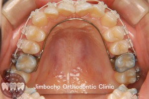 (ブログ) 「矯正歯科治療とバンド」4