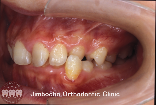 (症例2-1) 過蓋咬合3