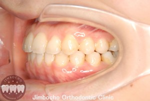 (症例1-2) 空隙歯列（すきっ歯）4