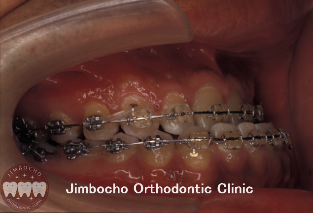 (ブログ) 「反対咬合（受け口）治療のタイミング」16