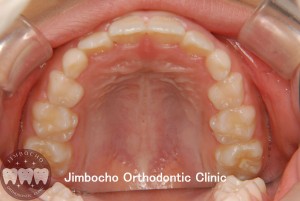 (症例1-2) 過蓋咬合4