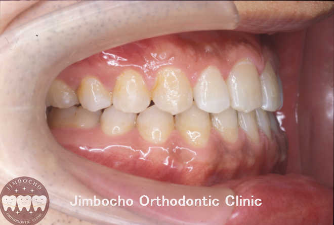 (ブログ) 「反対咬合（受け口）治療のタイミング」18