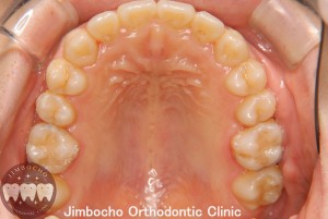(症例1-2) 空隙歯列（すきっ歯）5