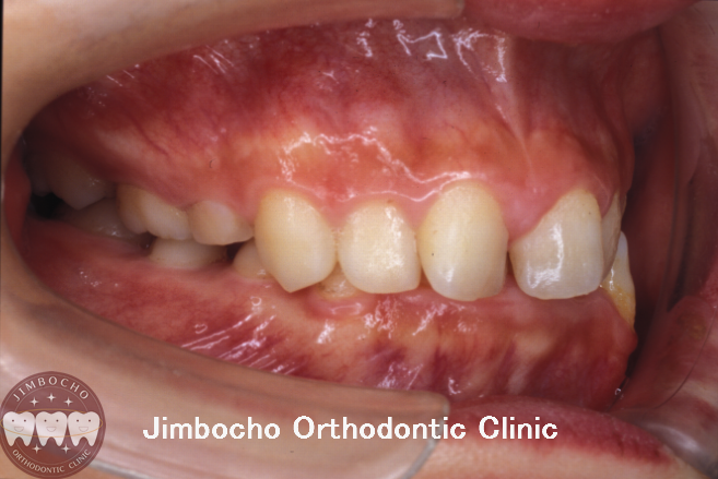 (症例2-1) 過蓋咬合2