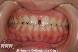 (症例2-1) 空隙歯列（すきっ歯）1