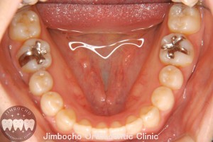 (症例1-2) 空隙歯列（すきっ歯）6