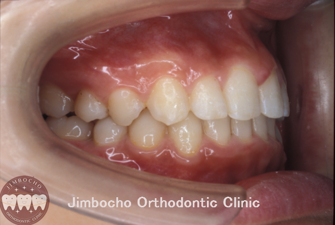 (症例2-2) 過蓋咬合2