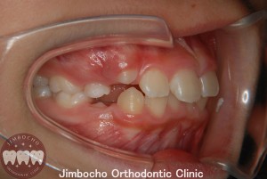 (症例3-1) 空隙歯列（すきっ歯）2