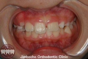 (症例3-1) 空隙歯列（すきっ歯）1