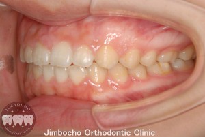 (症例2-2) 空隙歯列（すきっ歯）3