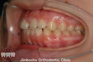 (症例2-1) 空隙歯列（すきっ歯）3