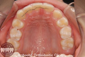 (症例3-2) 空隙歯列（すきっ歯）1
