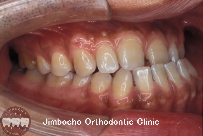 (ブログ) 「反対咬合（受け口）治療のタイミング」14