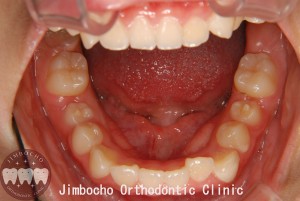 (ブログ) 「“中心結節”角が生えた歯？は要注意！」2