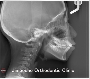 (ブログ) 「矯正の精密検査、セファロとは？」1