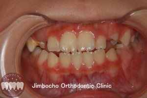 反対咬合３－１ (2)