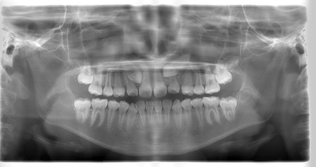 (X-p)(パノラマ) 上顎埋伏犬歯