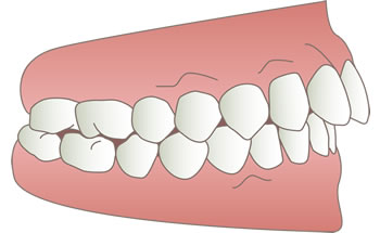 上顎前突（出っ歯）のイラスト