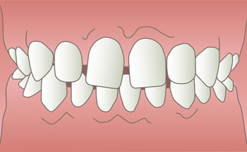 空隙歯列（すきっ歯）のイラスト