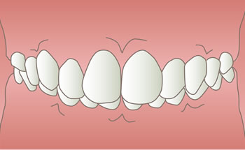 過蓋咬合（咬み合わせが深い）のイラスト